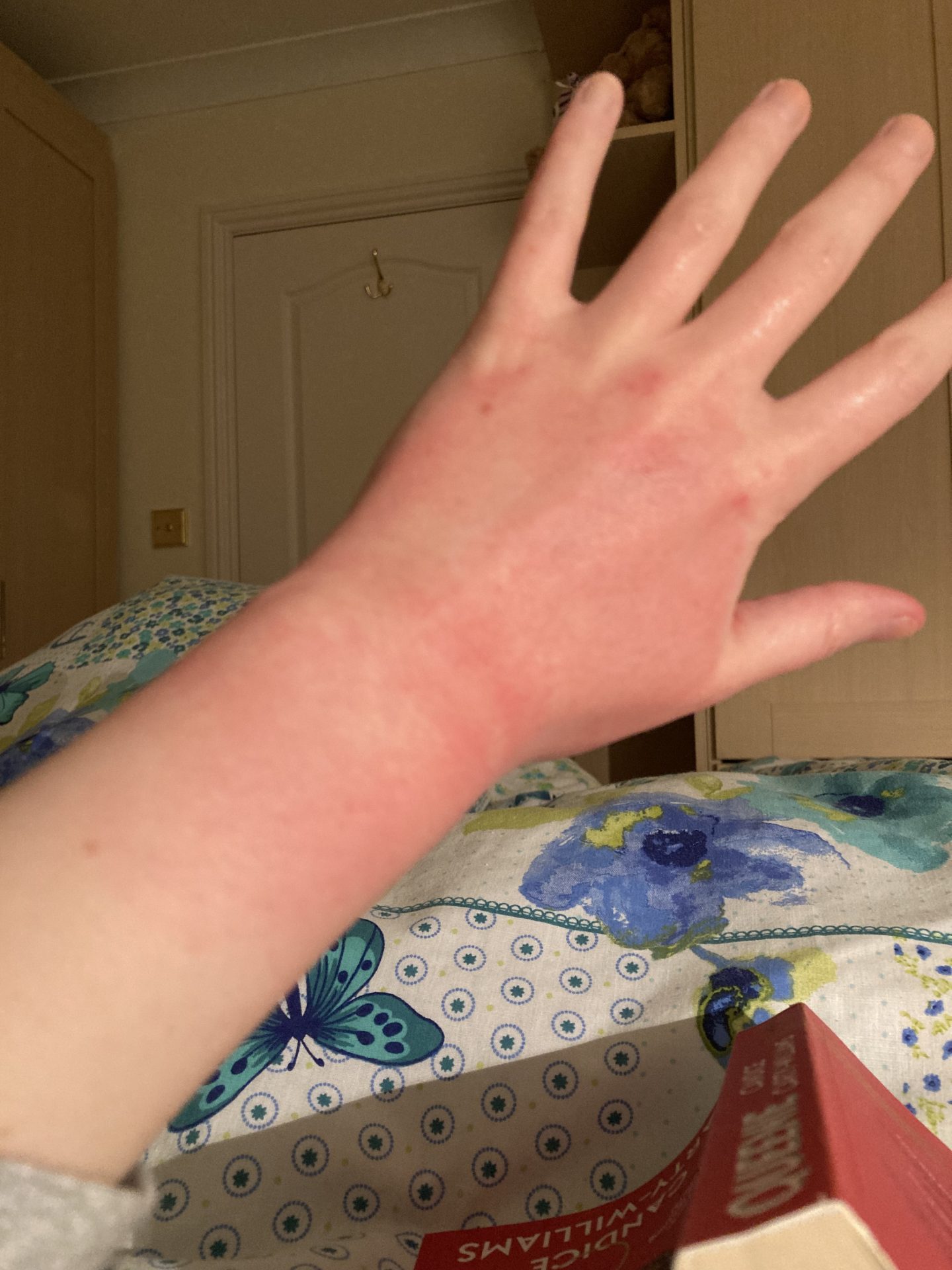 Pippa's hand as she's laid in bed reading. From the knuckles down to the top of the wrist, the skin is bright red and books sore, with two especially deep lines around the wrist joint.